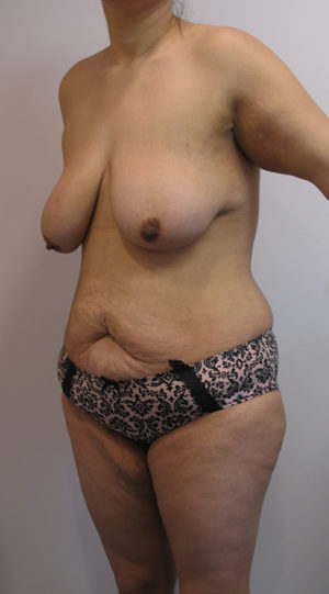 Mommy Makeover Case 3941 Before Photo Mommy Makeover