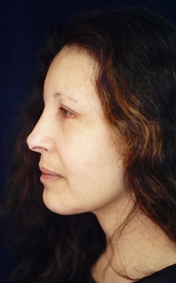 Chin Augmentation