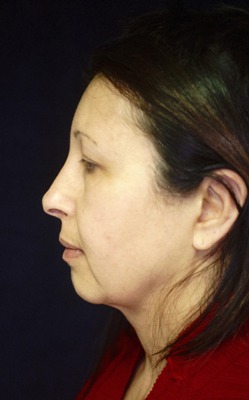 Chin Augmentation