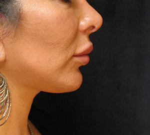 Chin Augmentation