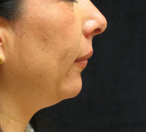 Chin Augmentation