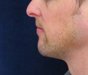 Chin Augmentation