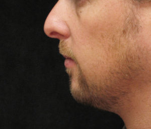 Chin Augmentation