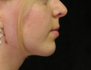 Chin Augmentation Case 29438 After Photo Chin Augmentation