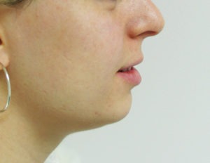 Chin Augmentation Case 29438 Before Photo Chin Augmentation