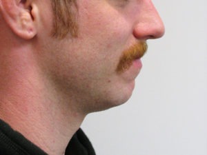 Chin Augmentation