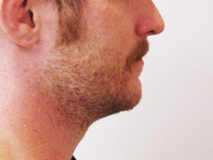 Chin Augmentation