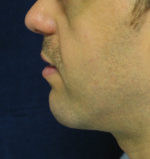 Chin Augmentation