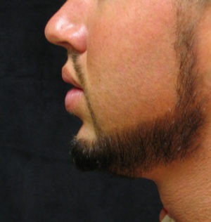 Chin Augmentation Case 29441 Before Photo Chin Augmentation