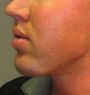 Chin Augmentation Case 29441 After Photo Chin Augmentation