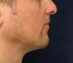 Chin Augmentation