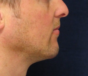 Chin Augmentation