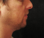 Chin Augmentation