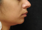 Chin Augmentation