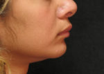 Chin Augmentation