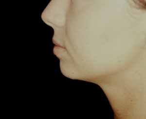 Chin Augmentation