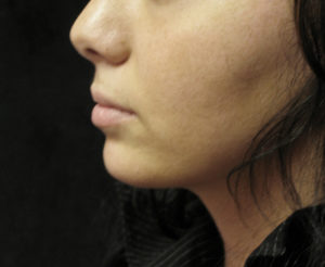 Chin Augmentation