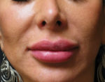 Lip Augmentation