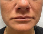 Lip Augmentation