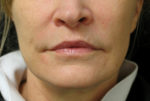 Lip Augmentation