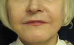 Lip Augmentation