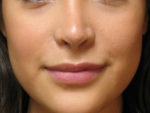 Lip Augmentation