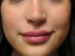 Lip Augmentation