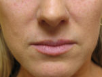 Lip Augmentation