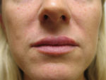 Lip Augmentation