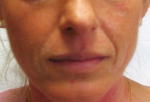 Lip Augmentation Case 31333 Before Photo Lip Augmentation