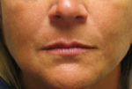 Lip Augmentation