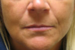 Lip Augmentation