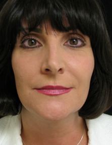 Cheek Augmentation Case 32095 After Photo Cheek Augmentation
