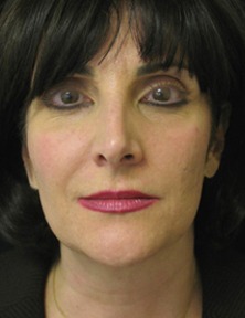Cheek Augmentation Case 32095 Before Photo Cheek Augmentation