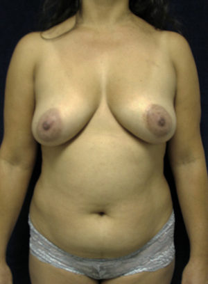 Breast Lift Case 63133 Before Photo Breast Lift