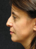 Nose Reshaping