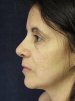 Nose Reshaping