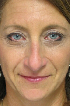 Nose Reshaping Case 91292 Before Photo Nose Reshaping