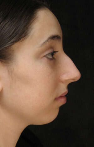 Nose Reshaping Case 91293 Before Photo Nose Reshaping