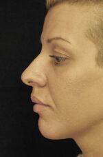 Nose Reshaping