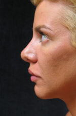 Nose Reshaping