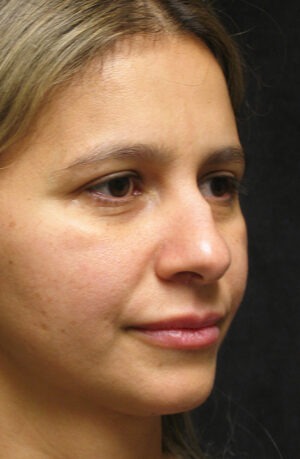 Nose Reshaping Case 91295 Before Photo Nose Reshaping