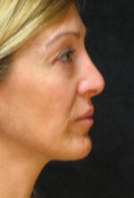 Nose Reshaping