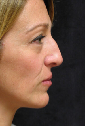 Nose Reshaping Case 91297 Before Photo Nose Reshaping