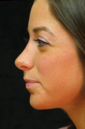 Nose Reshaping