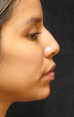 Nose Reshaping