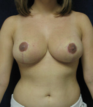 Breast Lift Case 91865 After Photo Breast Lift