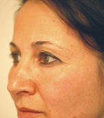 Blepharoplasty Eyelid Surgery Results Boston