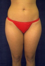 Liposuction Before & After