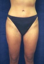 Liposuction Before & After